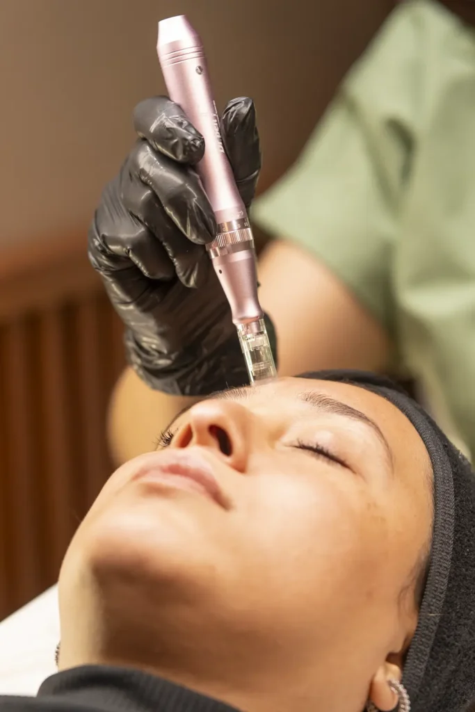 Experiencia Dermapen con Exosomas en Aira