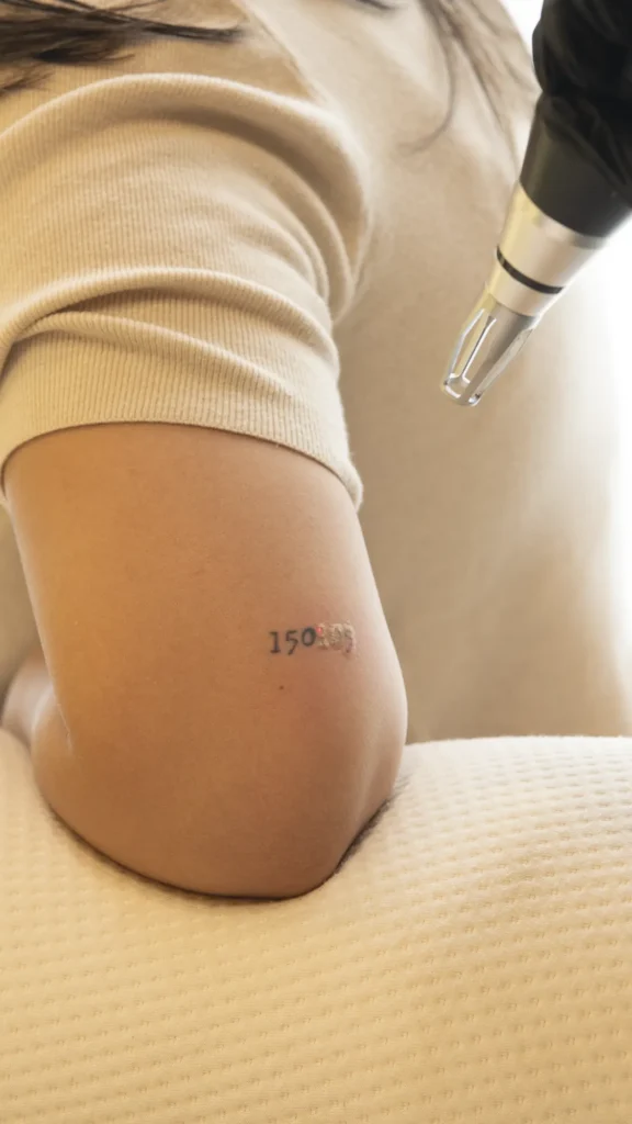 Experiencia Remoción de Tatuajes con Láser en Aira